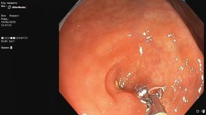 Круглый червь (острица) в толстой кишке. Колоноскопия, энтеробиоз, гельминтоз.