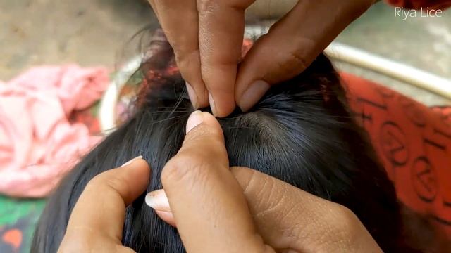 Remove Thousand Lice From Black Hair - Getting Out All Head Lice From Hair