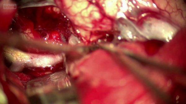 аневризма сма