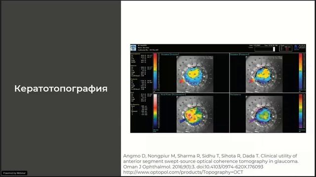 Цикл лекций по ОКТ Исследование переднего отрезка при глаукоме Пахиметрия смотреть онлайн
