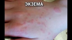 Красные пятна на теле