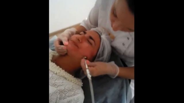 Алмазный пилинг-бриллиантовая кожа! Микродермабразия. смотреть онлайн