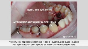 Приживается или не приживается зуб при пересадке – приживаемость зубов при аутотрансплантации