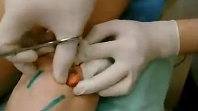 Удаление жировика (липомы) смотреть онлайн