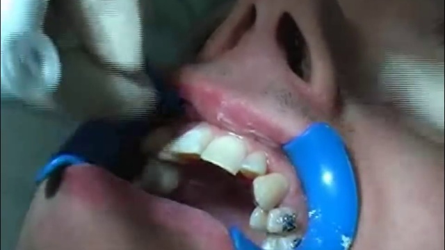 Приклеивание брекетов 