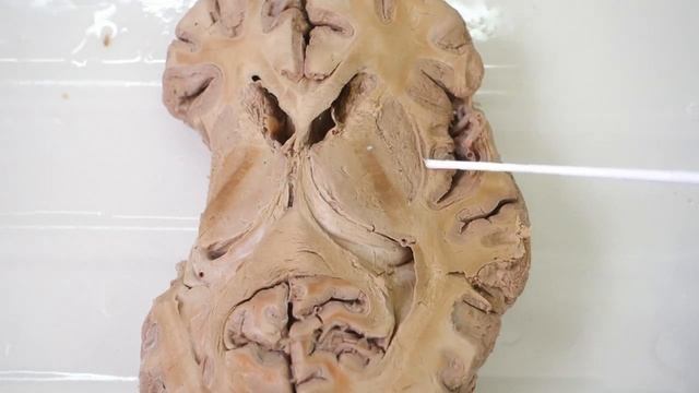 Базальные ядра головного мозга