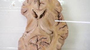 Базальные ядра головного мозга