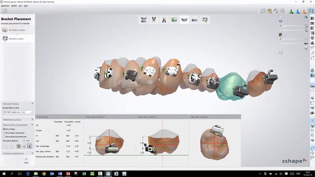 элайнеры смотреть онлайн