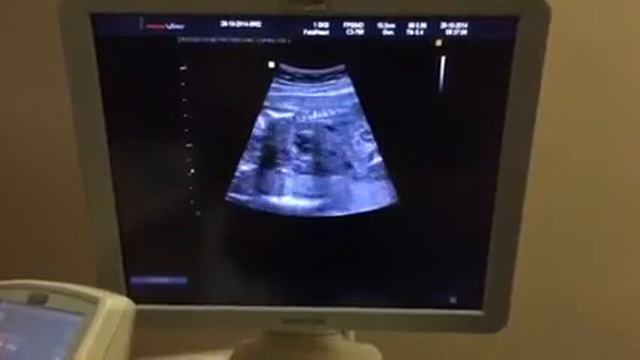 Узи 20 недель смотреть онлайн