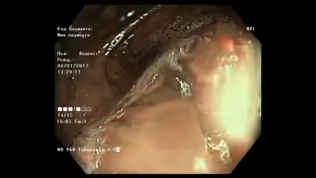 Screening colonoscopy in case of dolichocolon (full video) смотреть онлайн
