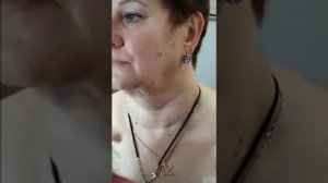 Липолитики для лица,волшебные уколы в подбородок