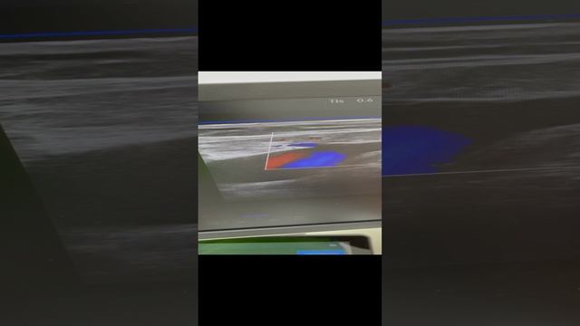 Варикоз и сосудистая сетка. Лечение варикоза. Узи сосудов. Флеболог Москва. Флеболог. смотреть онлайн