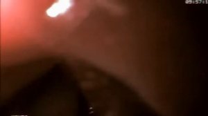 язва луковицы двенадцатиперстной кишки / фгдс / duodenal ulcer / gastroscopy