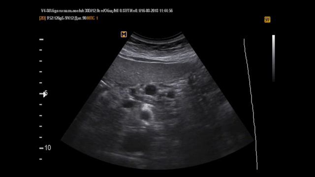 Кисты поджелудочной железы на УЗИ (29-8-18) смотреть онлайн