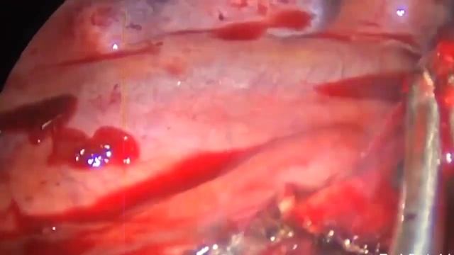 Asvide: Uniportal VATS dissection of subcarinal mediastinal lymph nodes (station 7) from the right… смотреть онлайн