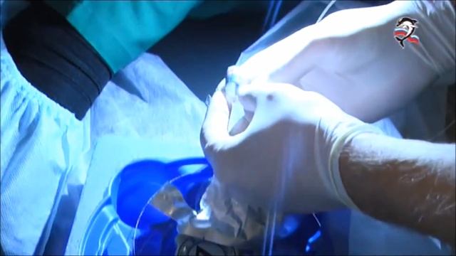 Лигирование ВРВП в Севастополе (1472 ВМКГ) смотреть онлайн