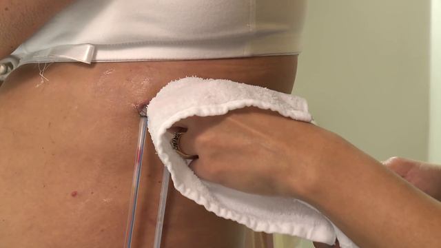 How to care for a post-surgery wound drainage system and gauze dressing смотреть онлайн