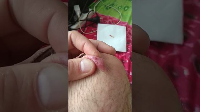 Что с моей ногой, самый большой прыщ или свищ,что это , смотреть онлайн
