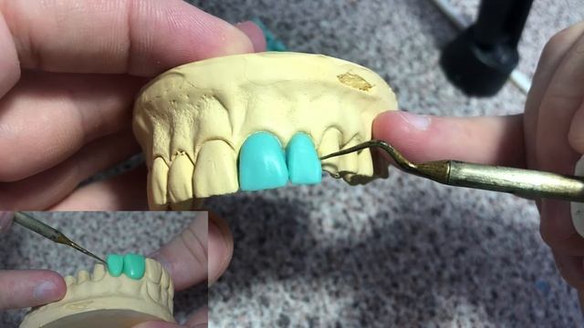 Моделировка зубов. Как моделировать боковой резец? Серия видео моделировки верхних зубов. смотреть онлайн