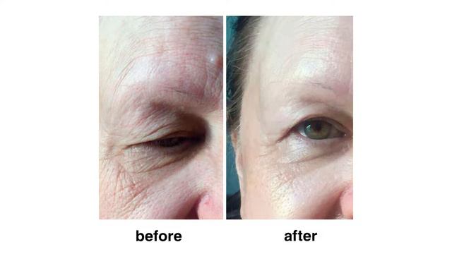 Результаты "до" и "после" процедуры смотреть онлайн