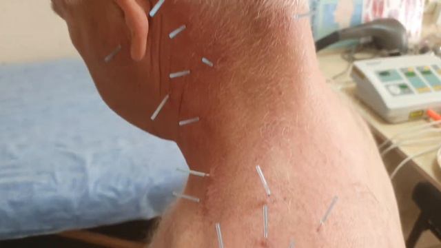 Шум в ухе. Индивидуальные точки. смотреть онлайн