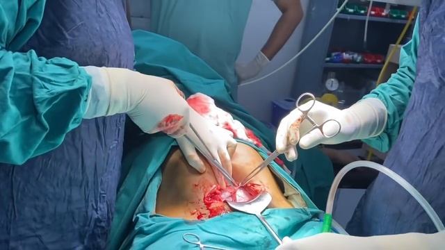How is Cesarean Section (LSCS) done? Cesarean Delivery me kya hota hai? смотреть онлайн