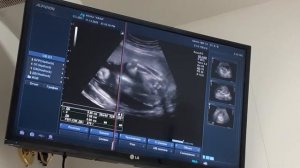 узи плода на сроке 29 30 недель скрининг