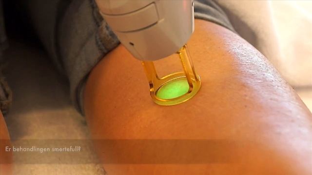 Hårfjerning Med Candela Gentlemax Pro Laser