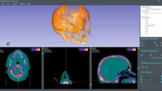 Creating label/landmark/point/fiducial marker on DICOM volume data смотреть онлайн