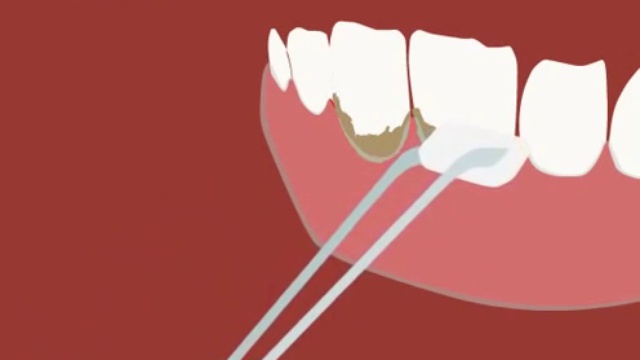 Химическое удаление зубного камня