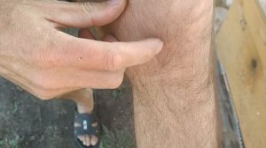 Апитерапия. Пчело-ужаливание.