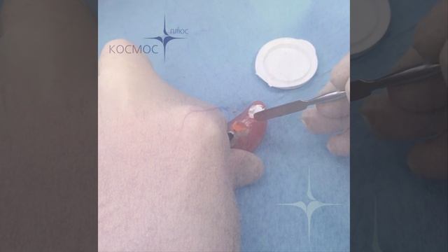 Выпала пломба из зуба (Часть Первая)!!! Что делать? смотреть онлайн