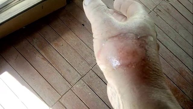 Озонированное масло ускоряет заживление ожога. смотреть онлайн