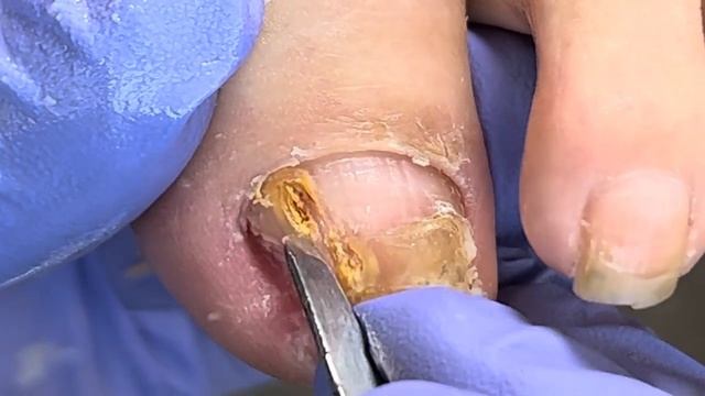 Wow ~ Amazing Ingrown Toenail, There Are 3 Layers!【Xue Yidao】