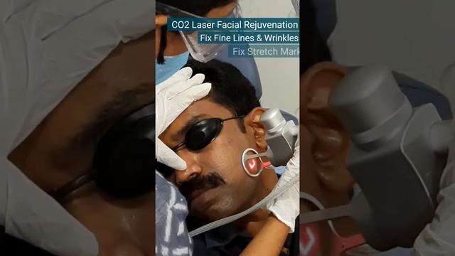 Co2 Laser Treatment смотреть онлайн