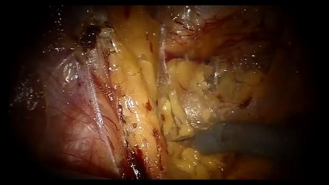 Pelvic lymph node dissection during Robotic radical prostatectomy | Full step | Dr Lucas Burttet смотреть онлайн