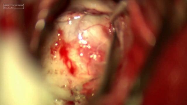 опухоль третьего желудочка 2. окклюзионная гидроцефалия смотреть онлайн