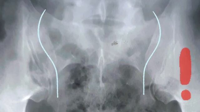 Асептический некроз головки бедренной кости. Лечение, курация. смотреть онлайн