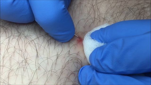 Ingrown Hair Removal On Man's Leg