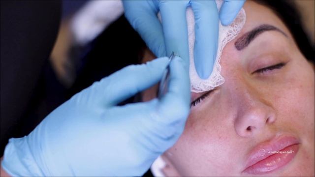 Eyebrow transplantation procedure. смотреть онлайн