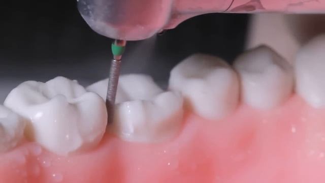 Алгоритм препарирования моляра набором BTKit смотреть онлайн