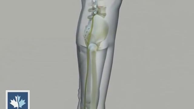 Sciatica | Spinal Decompression | Back Clinics of Canada смотреть онлайн