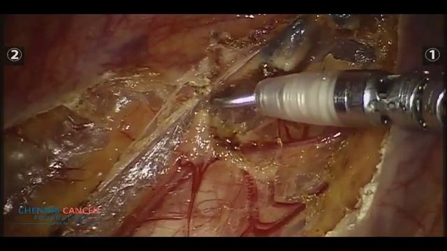 Robotic Esophagectomy - Superior Lymph Node Dissection смотреть онлайн