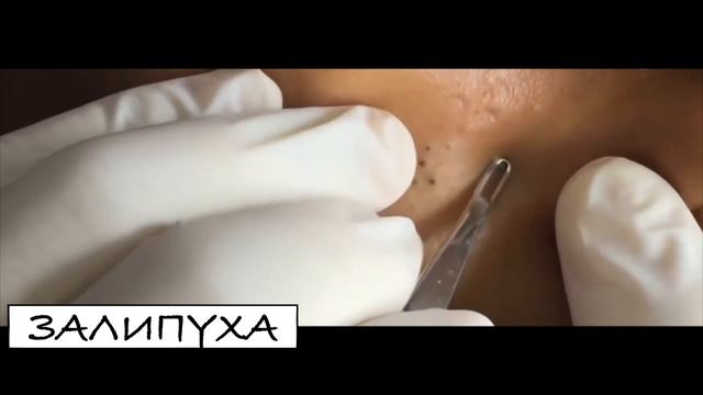 ВЫДАВЛИВАНИЕ ПРЫЩЕЙ. ВЫДАВЛИВАНИЕ ПРЫЩЕЙ. ВЫДАВЛИВАНИЕ ЧЕРНЫХ ТОЧЕК НА ЛИЦЕ. ПРЫЩИ ВЫДАВЛИВАНИЕ смотреть онлайн