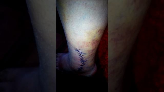 Закрытый перелом лодыжки со смещением моя история 2 часть