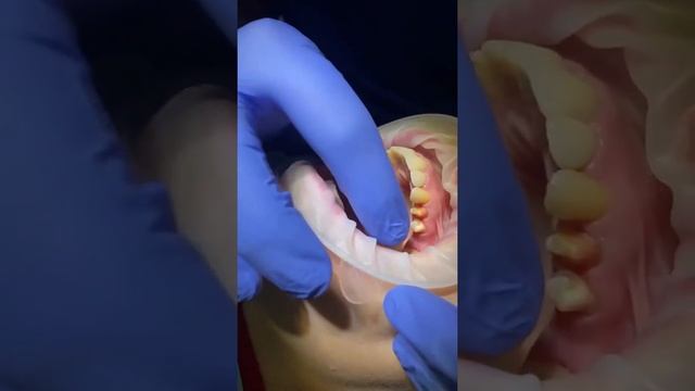 Фиксация коронок смотреть онлайн