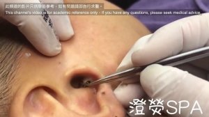 Огромная черная точка в ухе