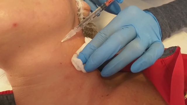 Mesoterapia Filorga NCTF 135HA