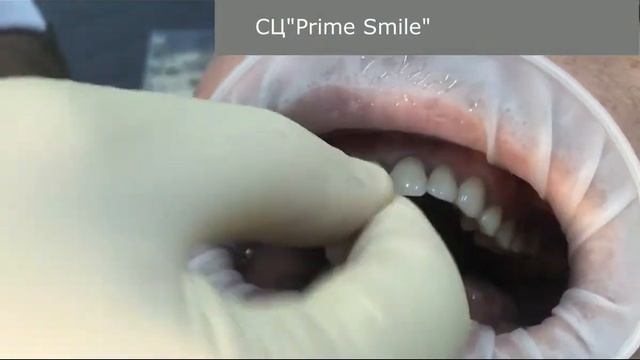 Пациенту вставили передний зуб (СЦ"Prime Smile") смотреть онлайн