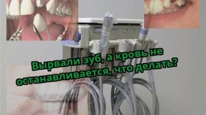 Вырвали зуб, а кровь не останавливается, что делать?